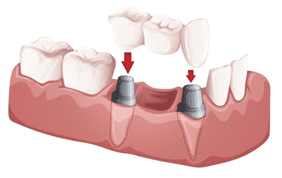 Choices-to-Dentures