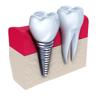 Dental-Crowns