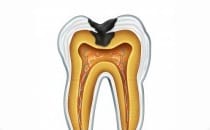 , Tooth Color Restorations
