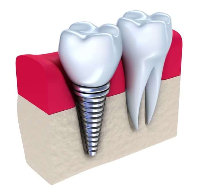 dental_implants