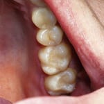 Tooth Color Restorations - Colored Teeth Fillings 