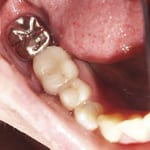 Dental Crowns 