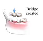 Dental Bridges