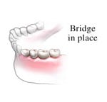 Dental Bridge