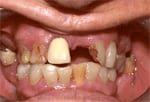 Parial Dentures