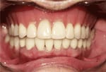 Parial Dentures