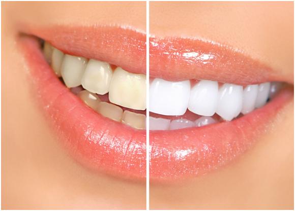 Give Your Smile A Makeover