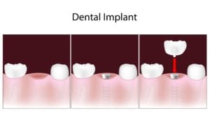 15167484 - dental implant procedure