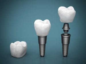 33091014 - dental implants on a beautiful blue background