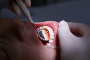 Periodontal Disease Prevention