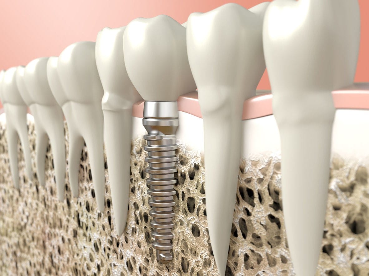 Dental Implants Hollywood FL