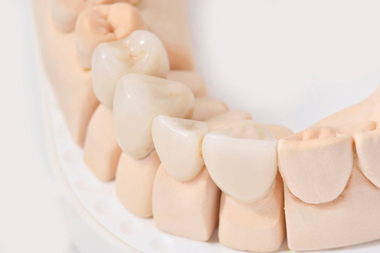 Alternatives to Dentures