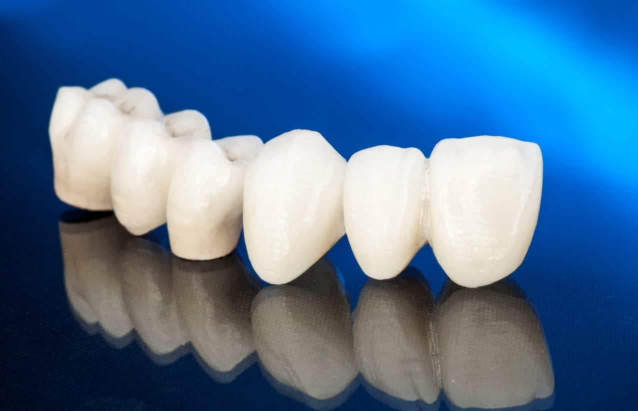 Why Bridges Are Becoming a Top Choice for Dental Patients