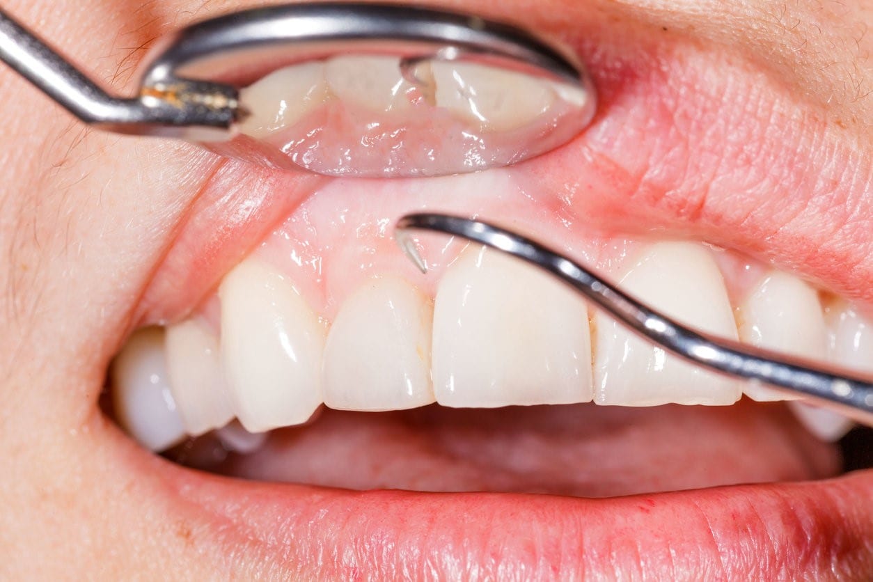 What Causes Gums to Recede – and How Do You Deal with It