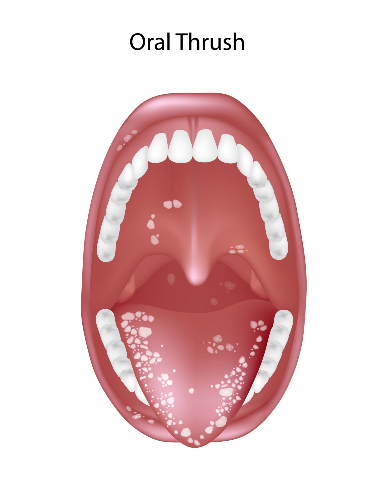 Oral Thrush Hollywood FL