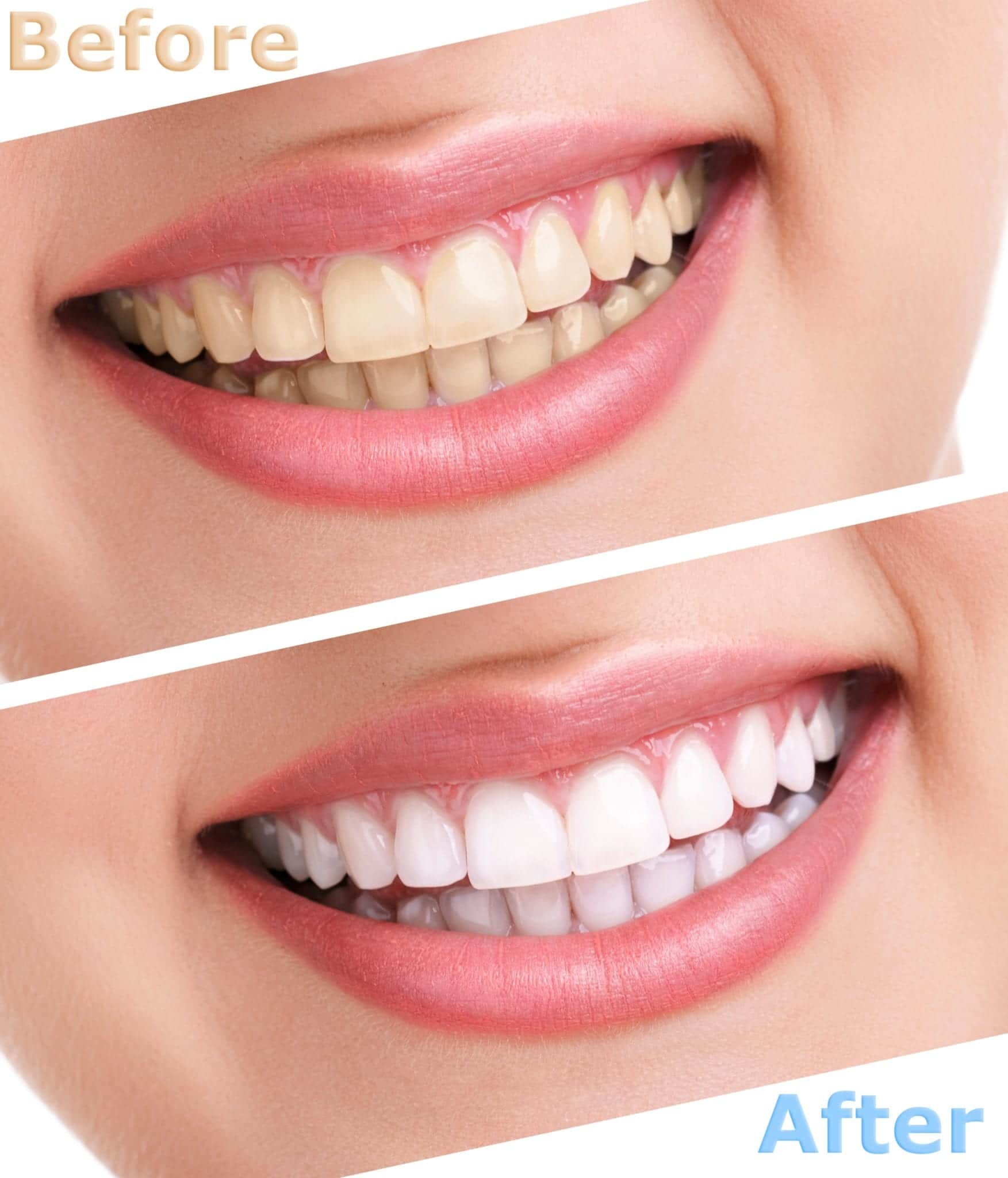 Teeth Whitening Hollywood FL