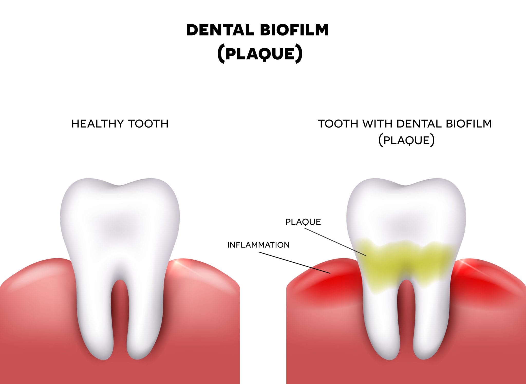 Plaque: Where It Comes From – and How to Stop It