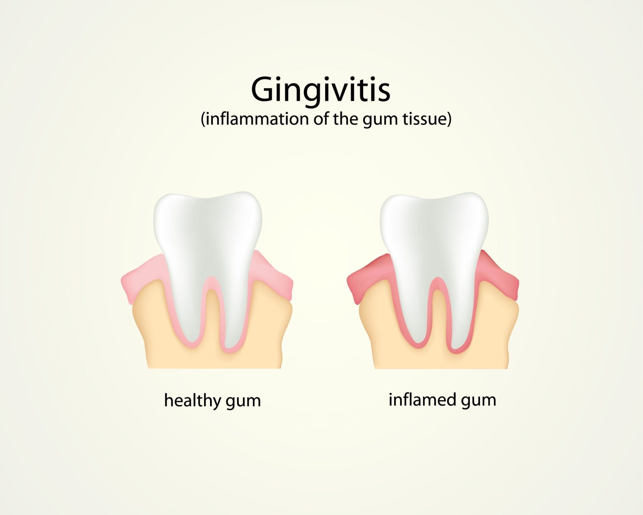 Gingivitis Treatment Hollywood FL