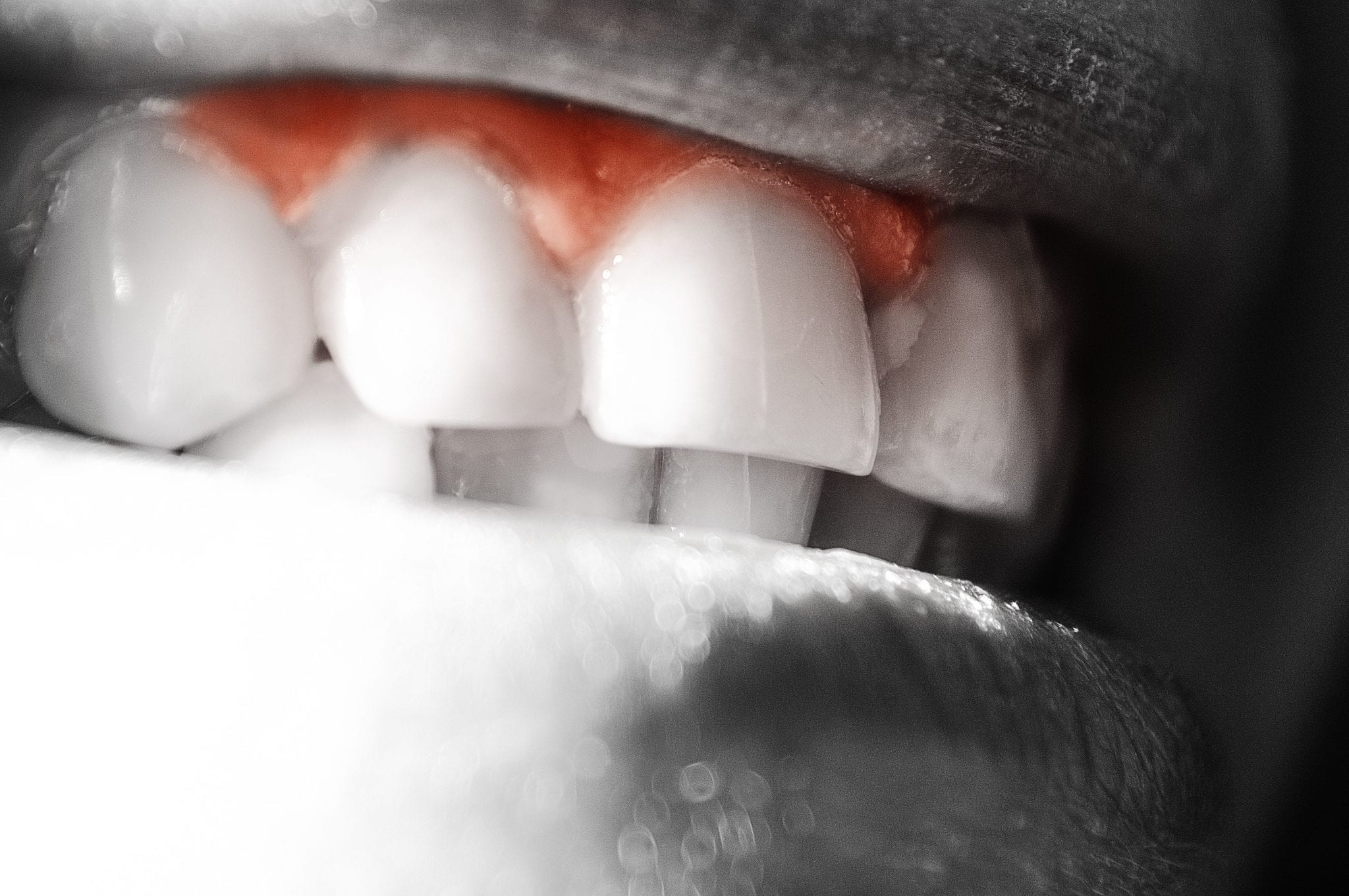 What Does It Mean If Your Gums are Bleeding?