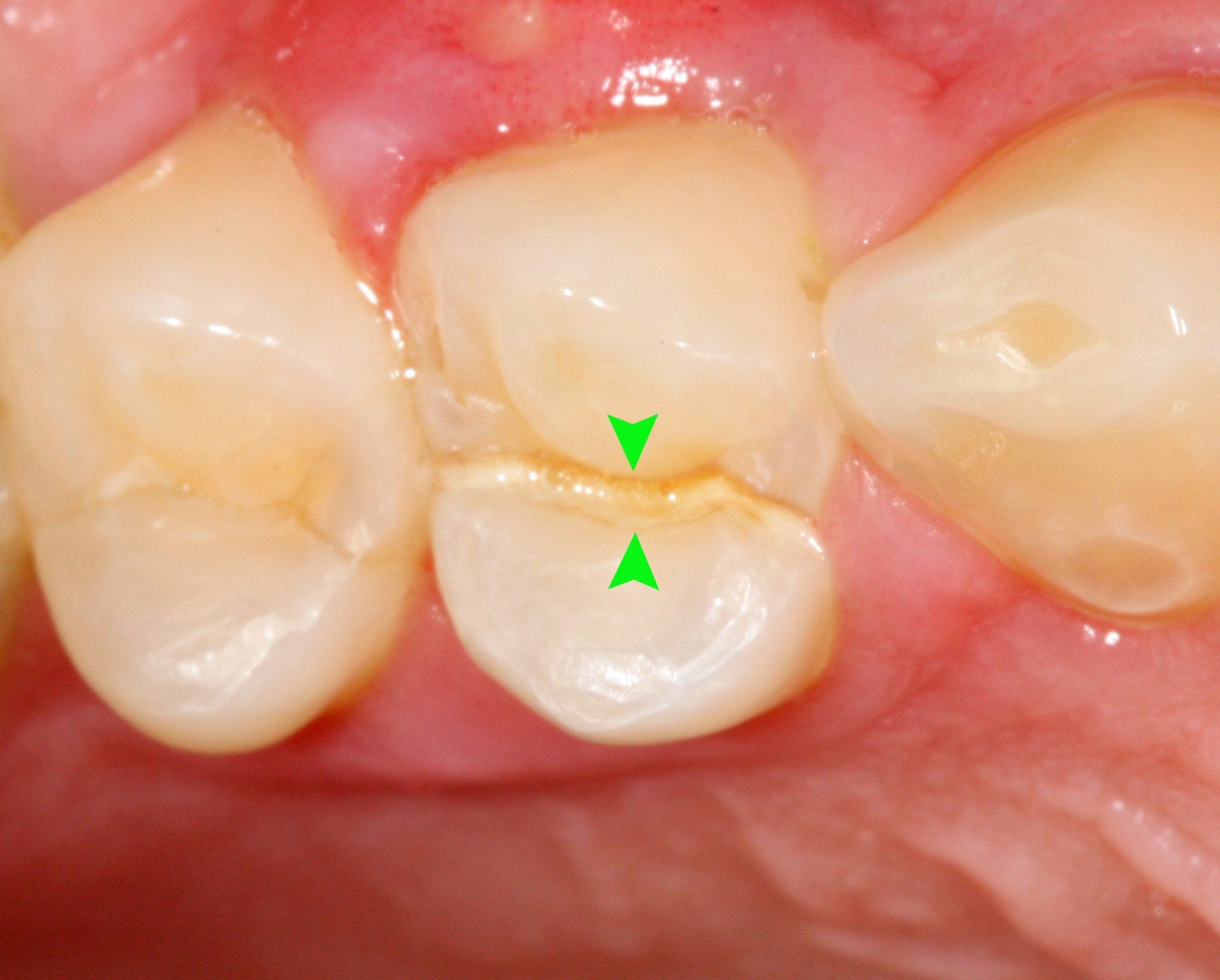 What to Know about Cracked Teeth and How to Treat Them