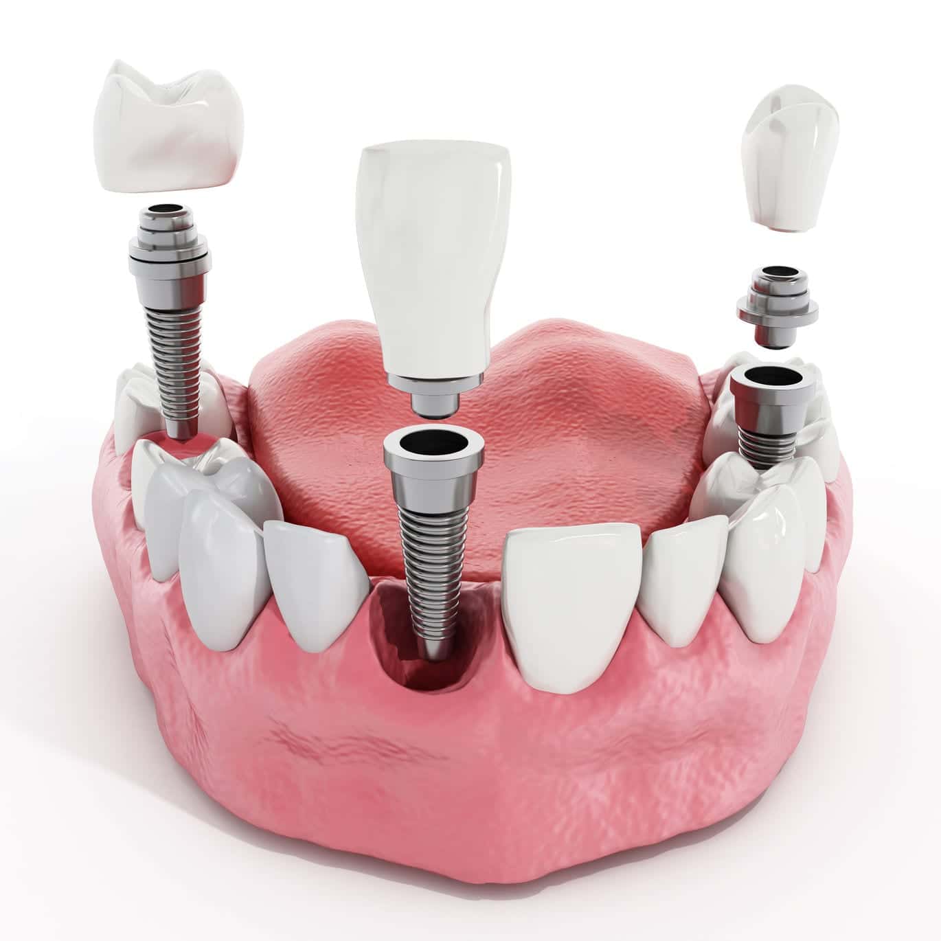 53127189 - illustration of teeth showing dental implant structure