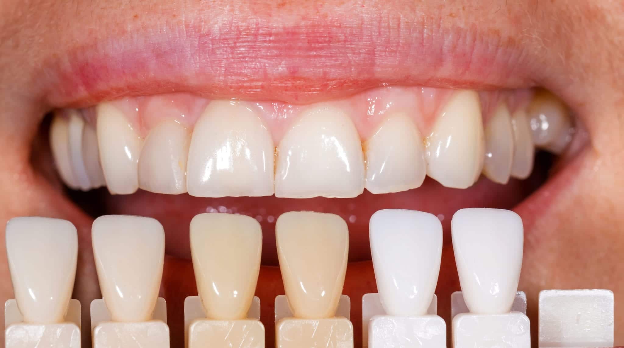 La grande differenza tra sbiancamento e colore dei denti Restauro