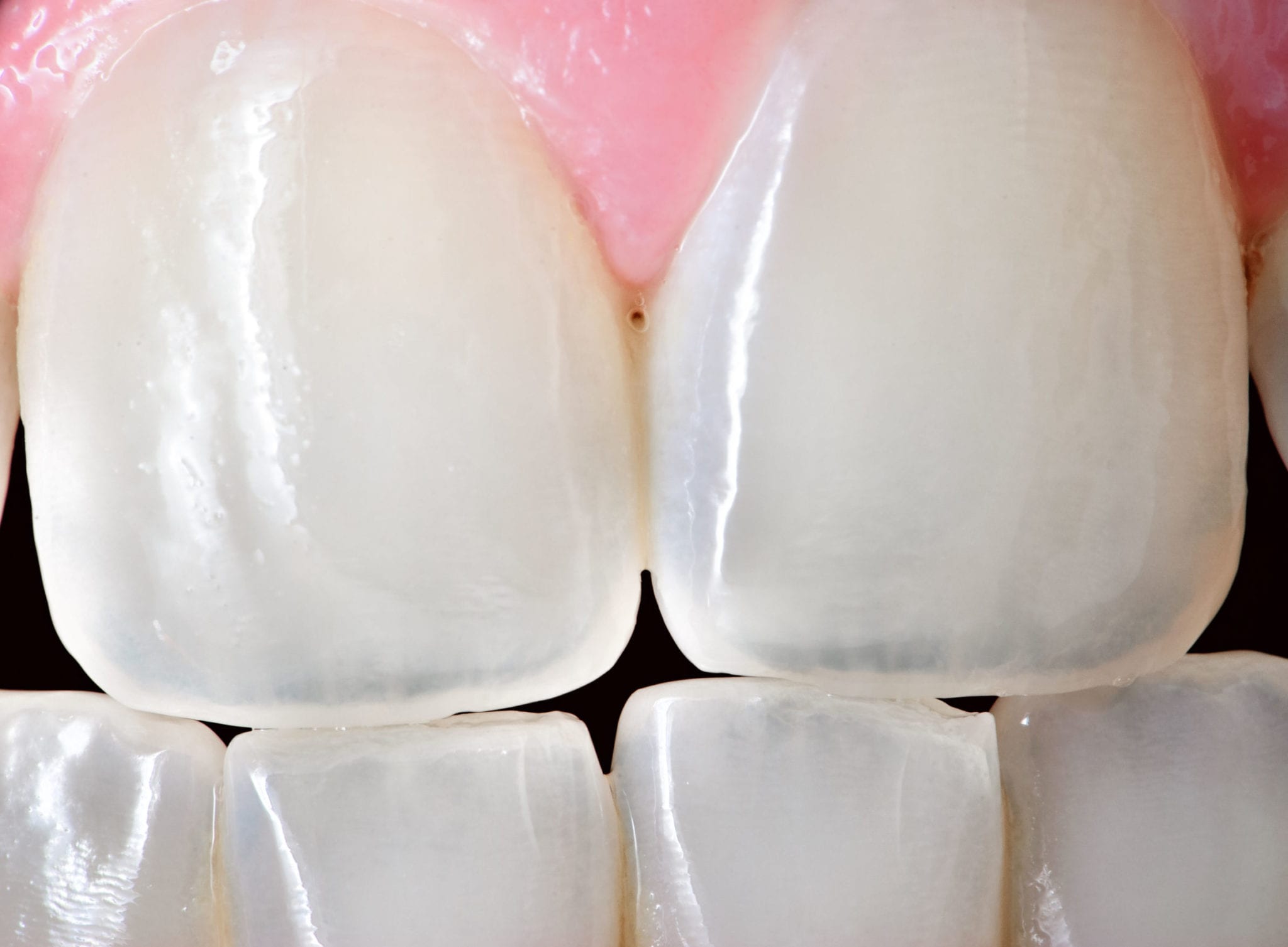 What Is Tooth Erosion and How Can Your Dentist Help?