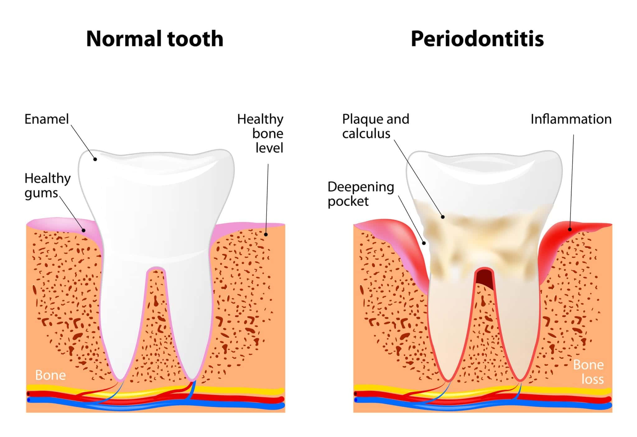 Regular Dental Cleaning vs Deep Cleaning: What is the Difference?