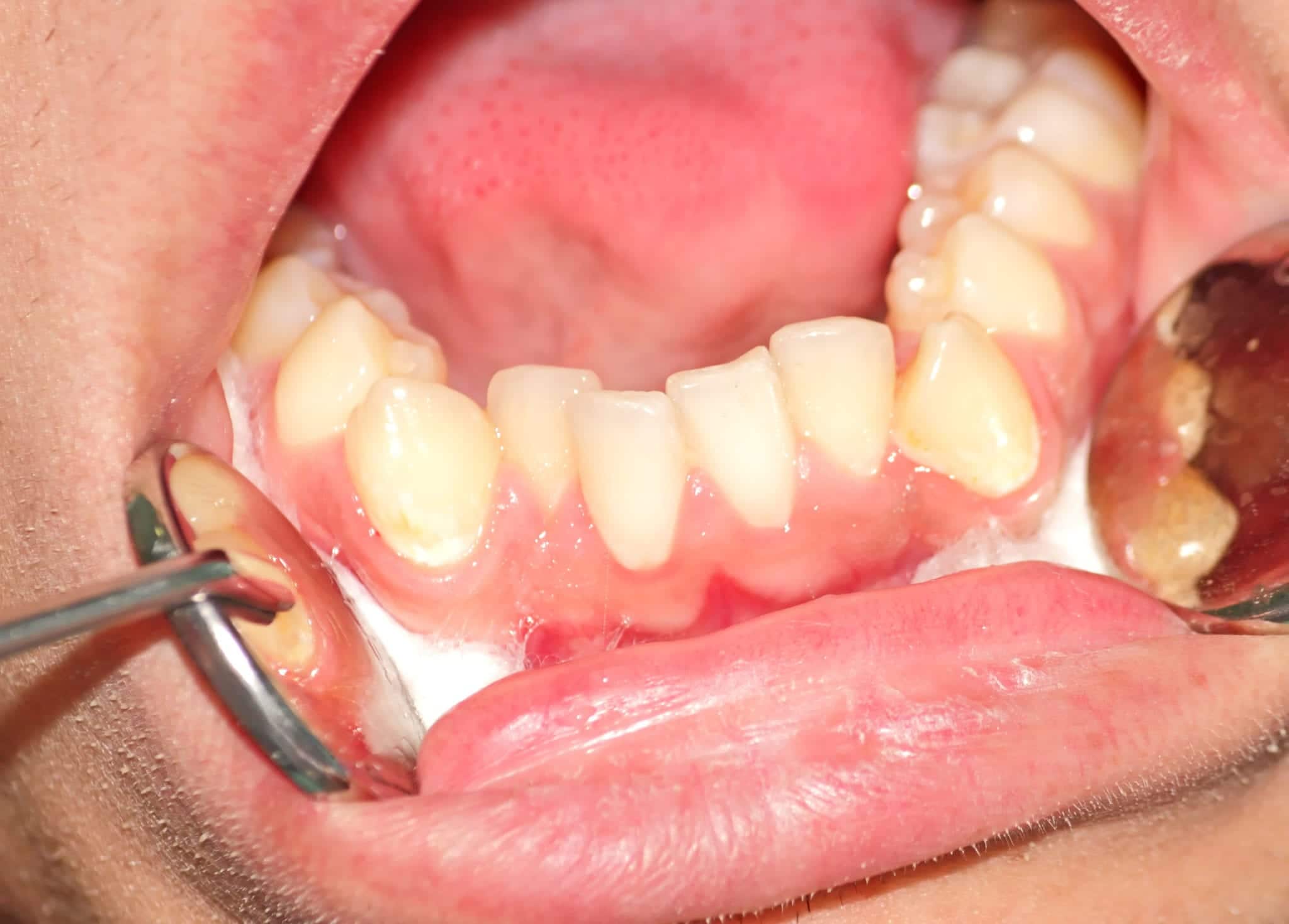 Crowded Teeth Dentist South Florida