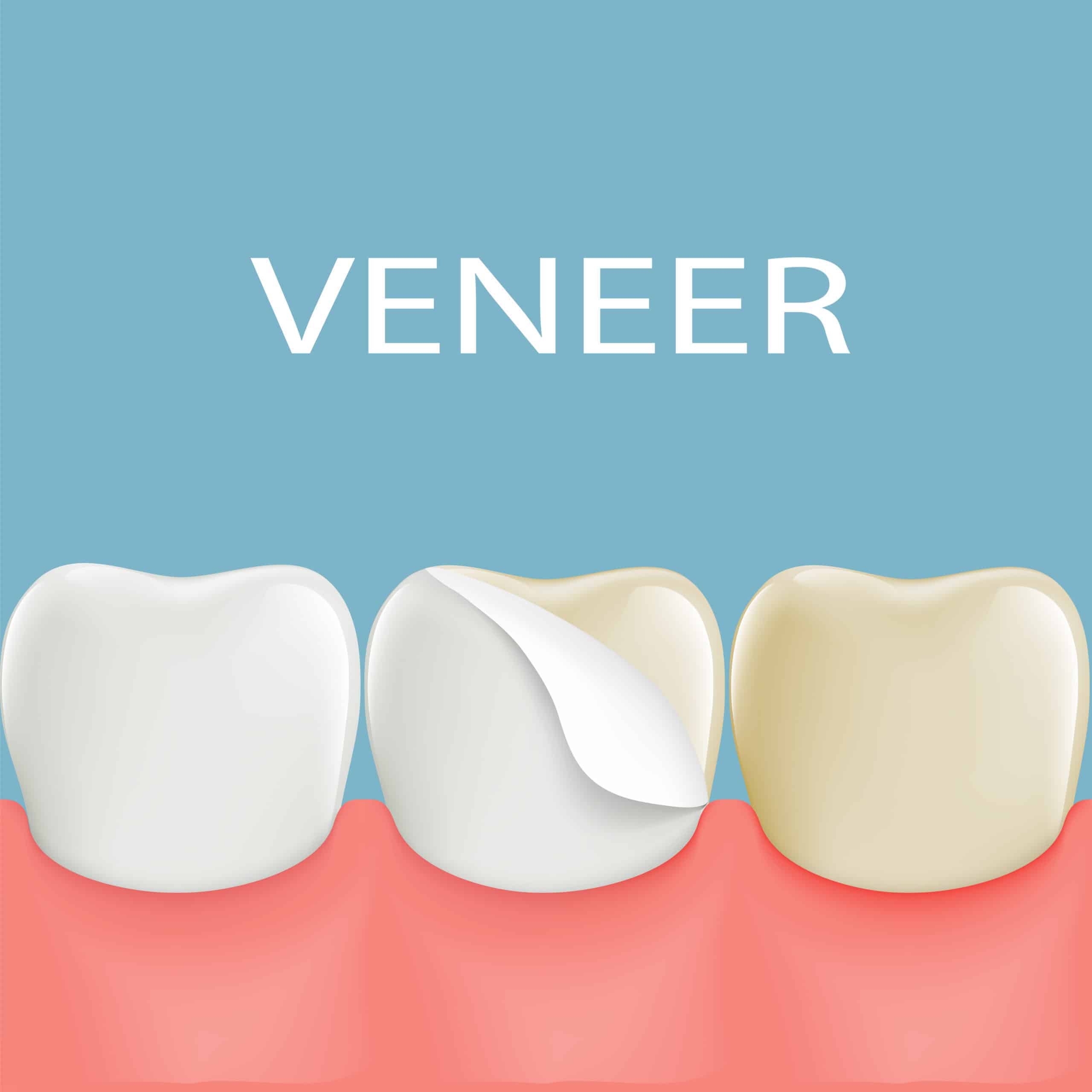Oral Health Issues You Need to Handle Before Getting Dental Veneers