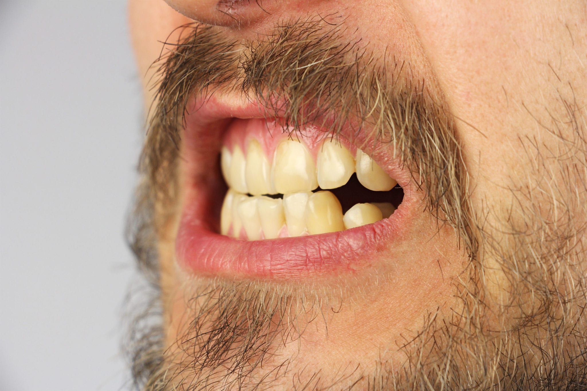 Tooth Wearing: Understanding the Dangers