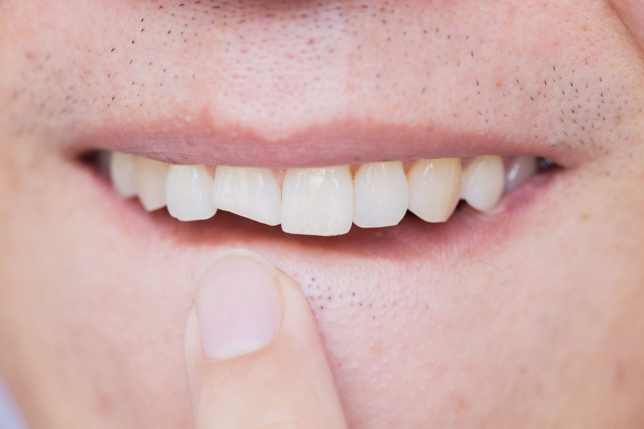What Is a Tooth Abscess and What Can You Do About It?
