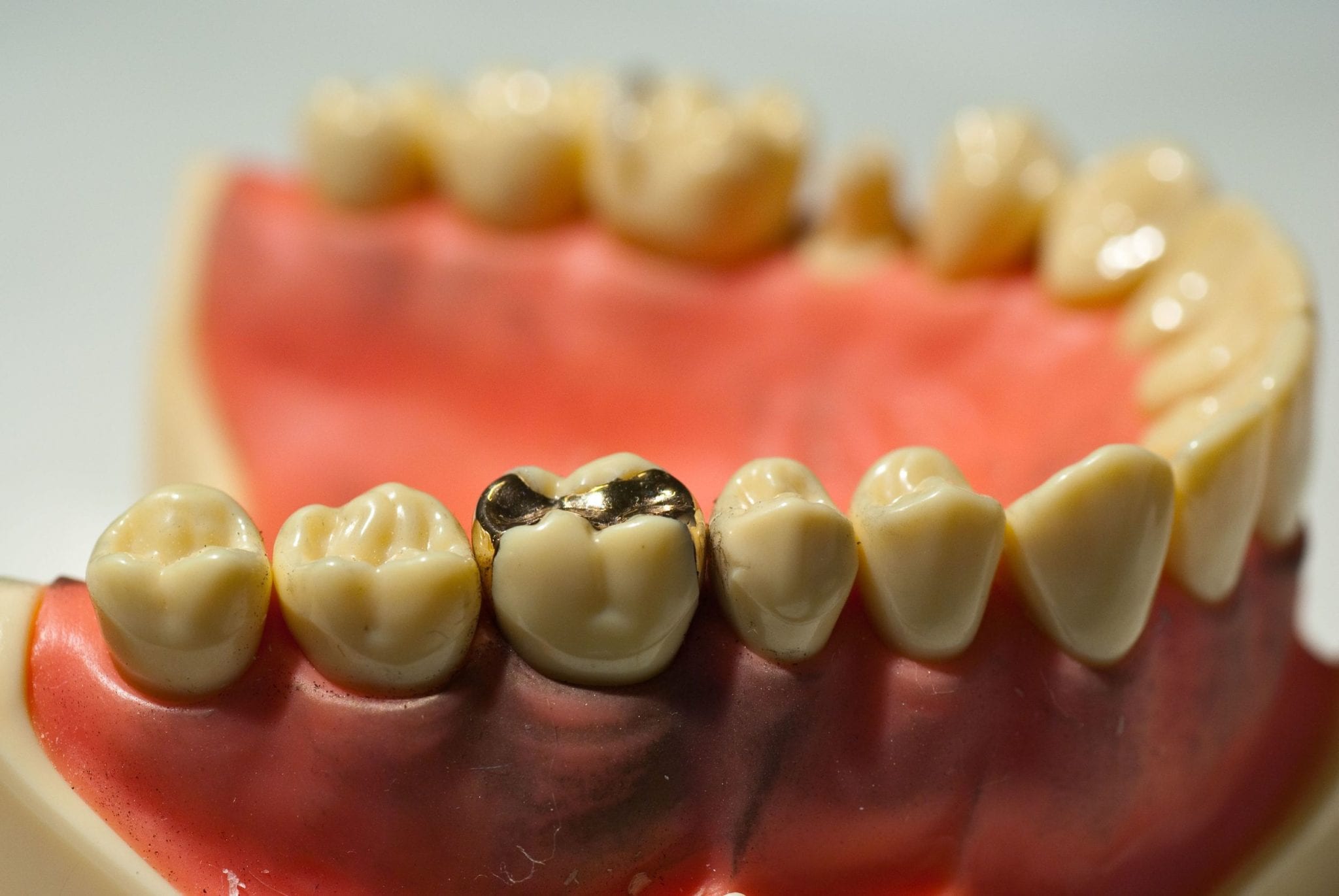 Are Fillings for Cavities Always Necessary? The Answer May Surprise You