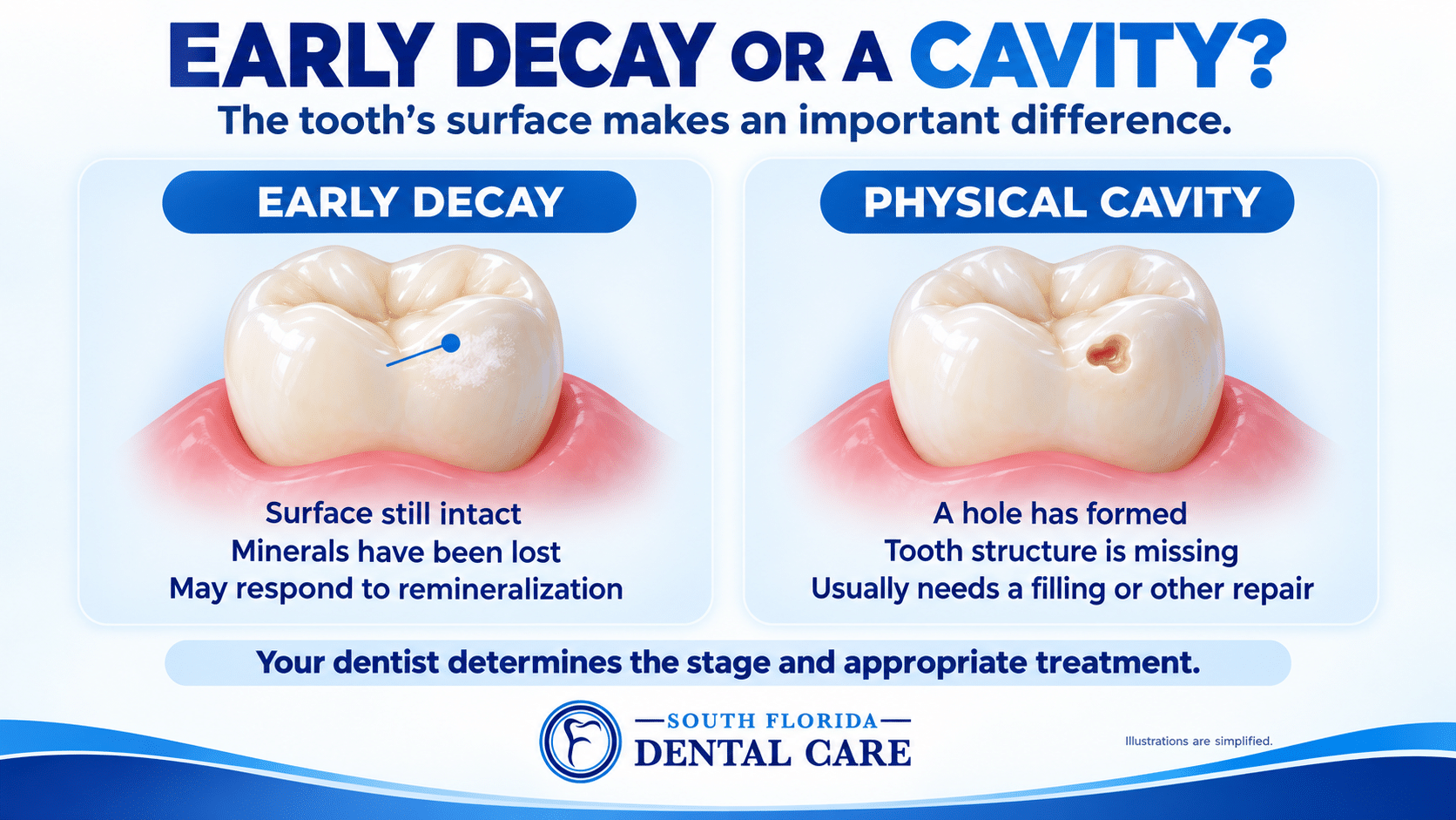 Side-by-side illustrations comparing early tooth decay with an intact surface and a physical cavity with missing tooth structure