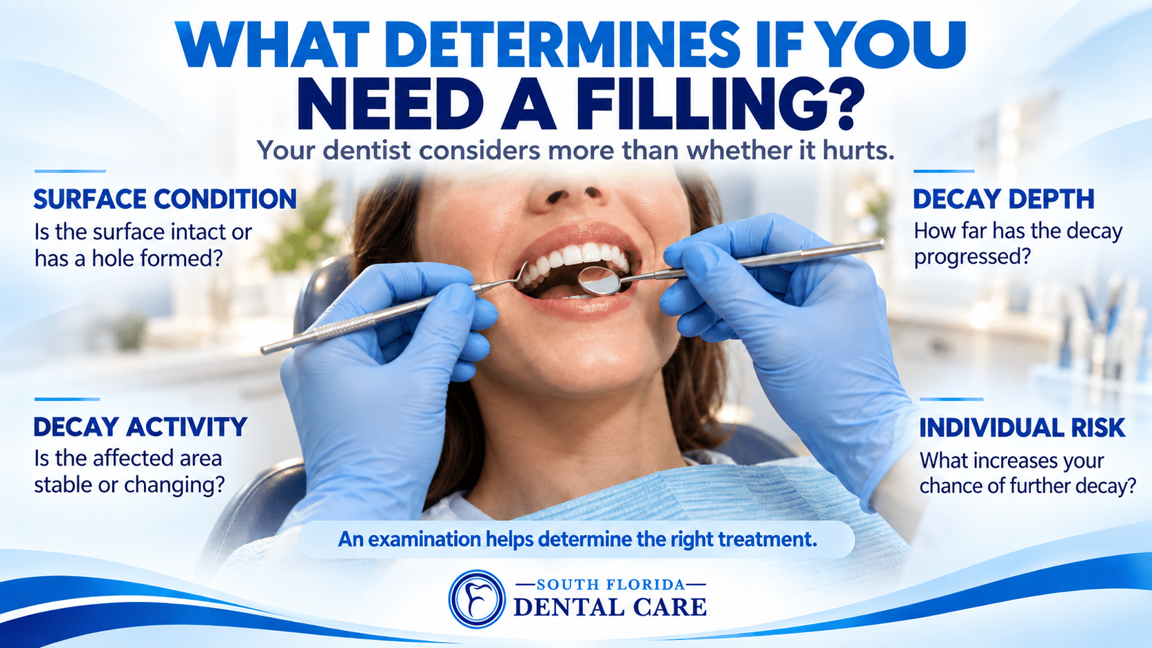 Dental examination using an explorer and mirror, surrounded by four factors dentists consider when recommending a filling