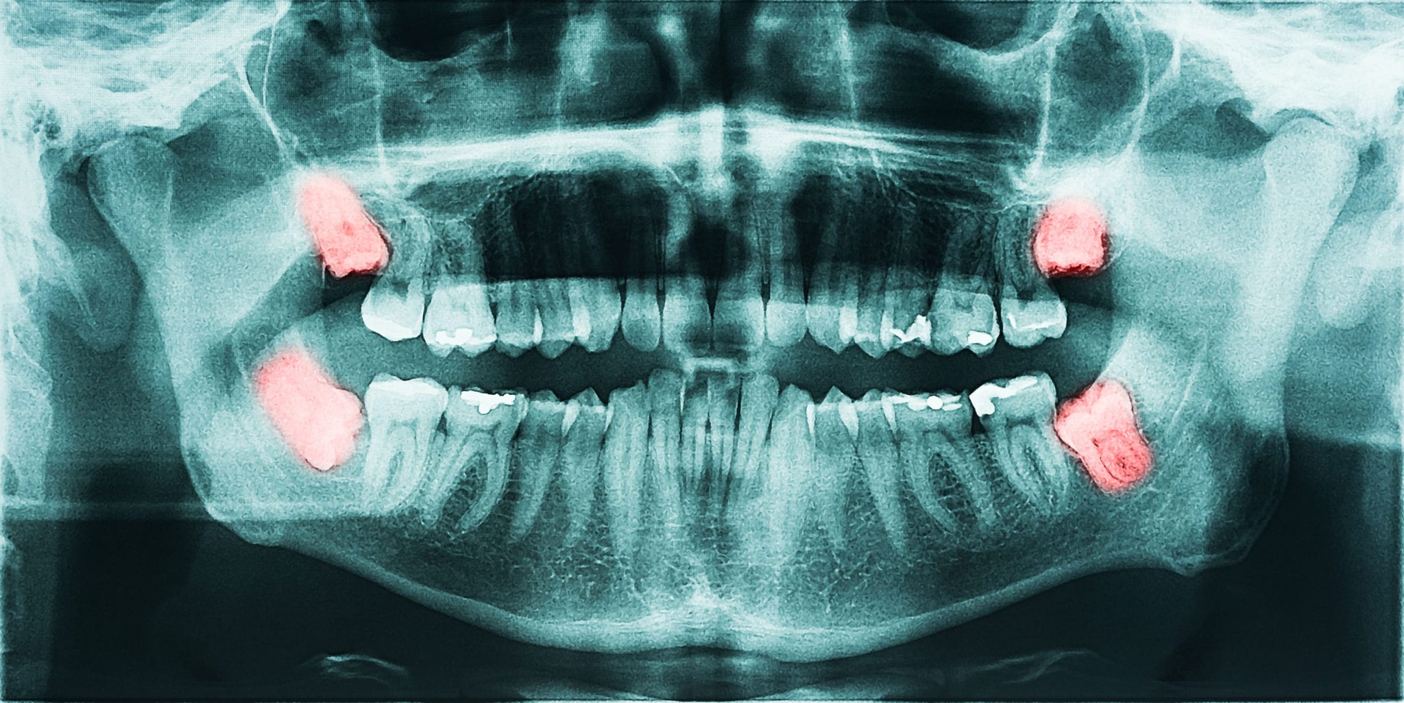 Hollywood FL Wisdom Tooth Extraction