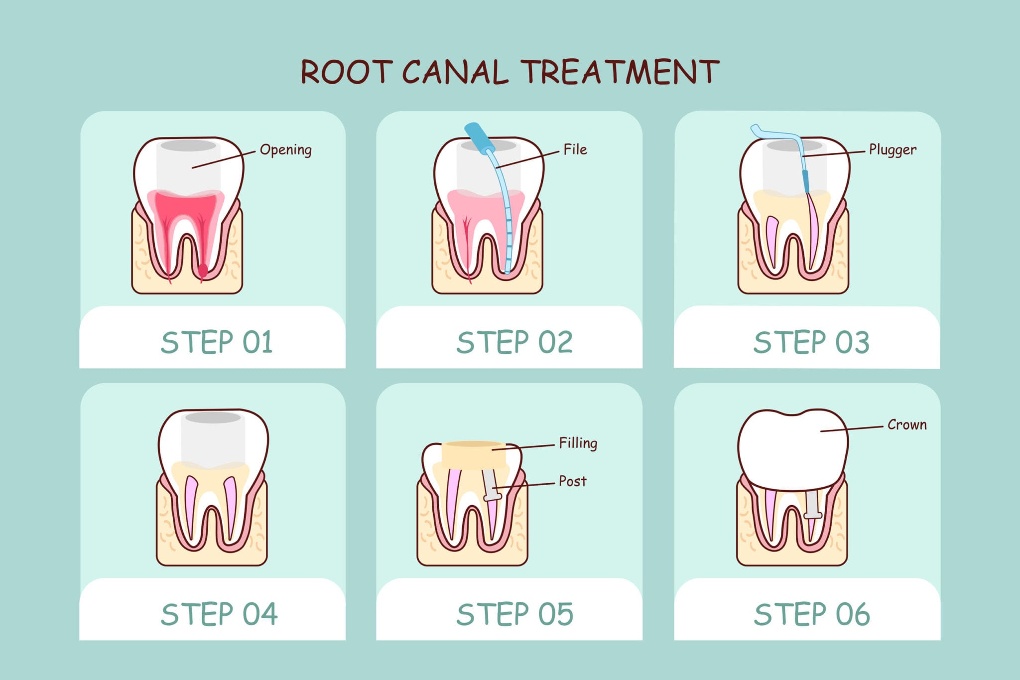 Do Root Canals Really Hurt? The Answer May Surprise You...