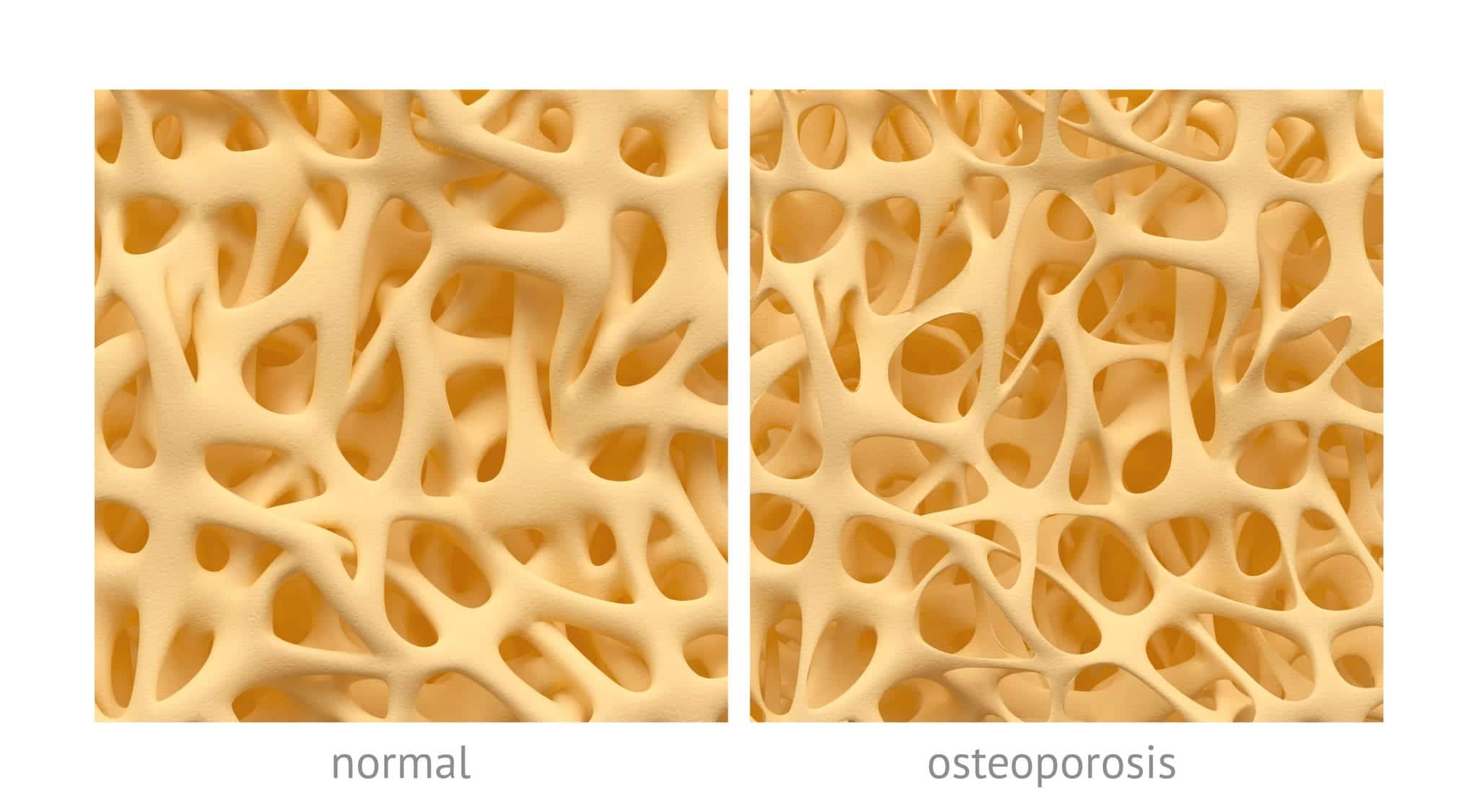 Osteoporosis: Why Your Dentist Might Be Your First Line of Defense