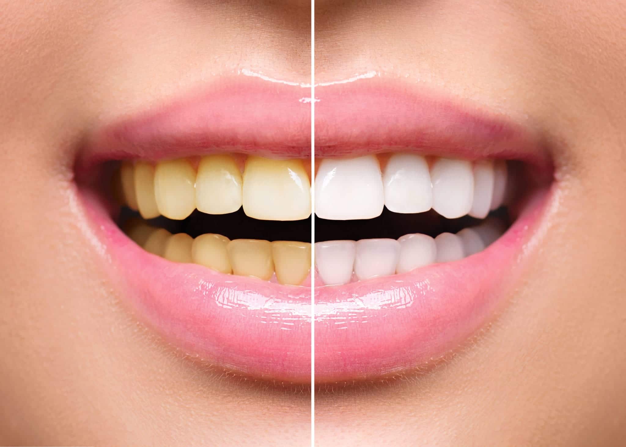 , Your Guide to How Teeth Stains Happen
