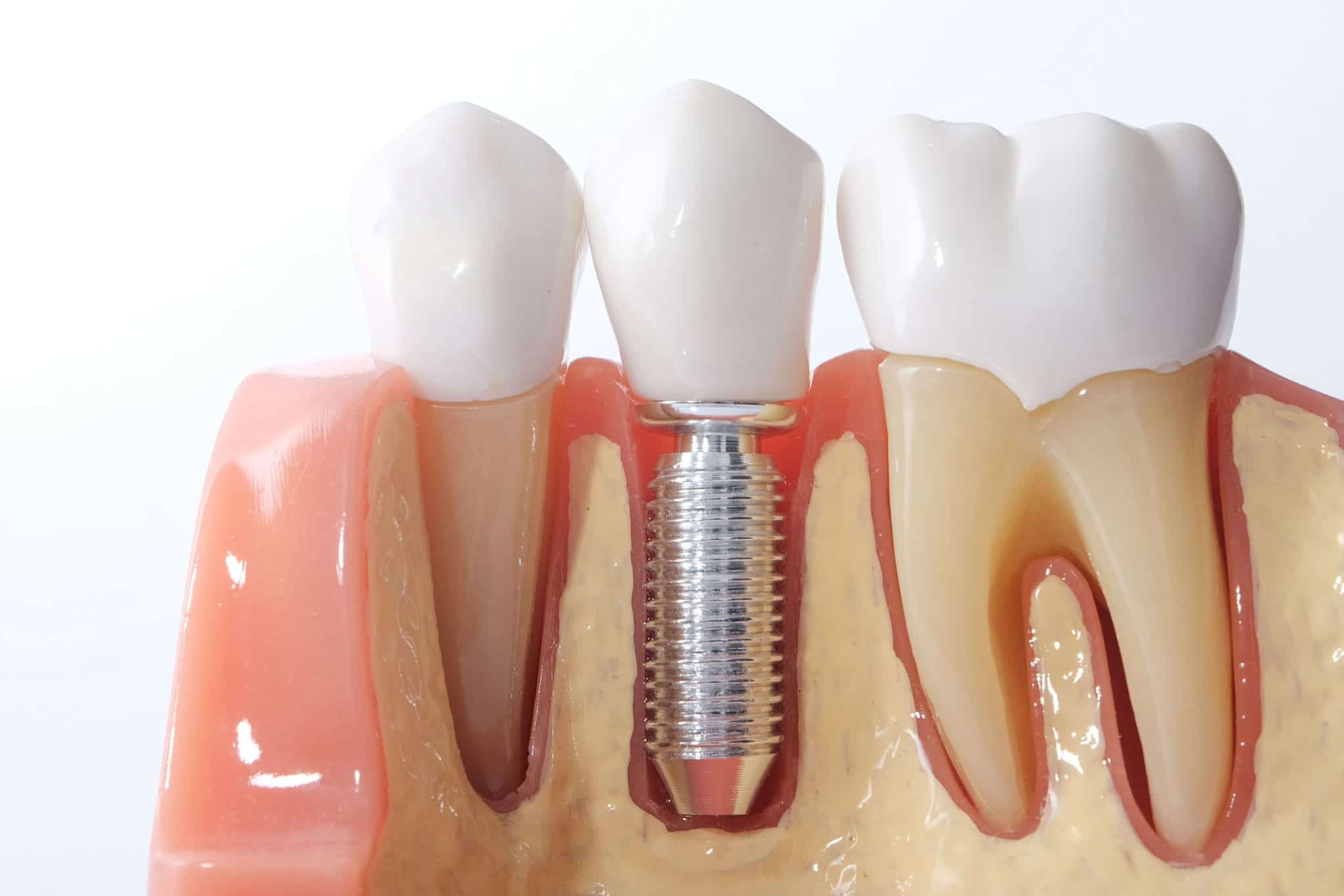 Dental Implants: A Guide to the Most Frequently Asked Questions