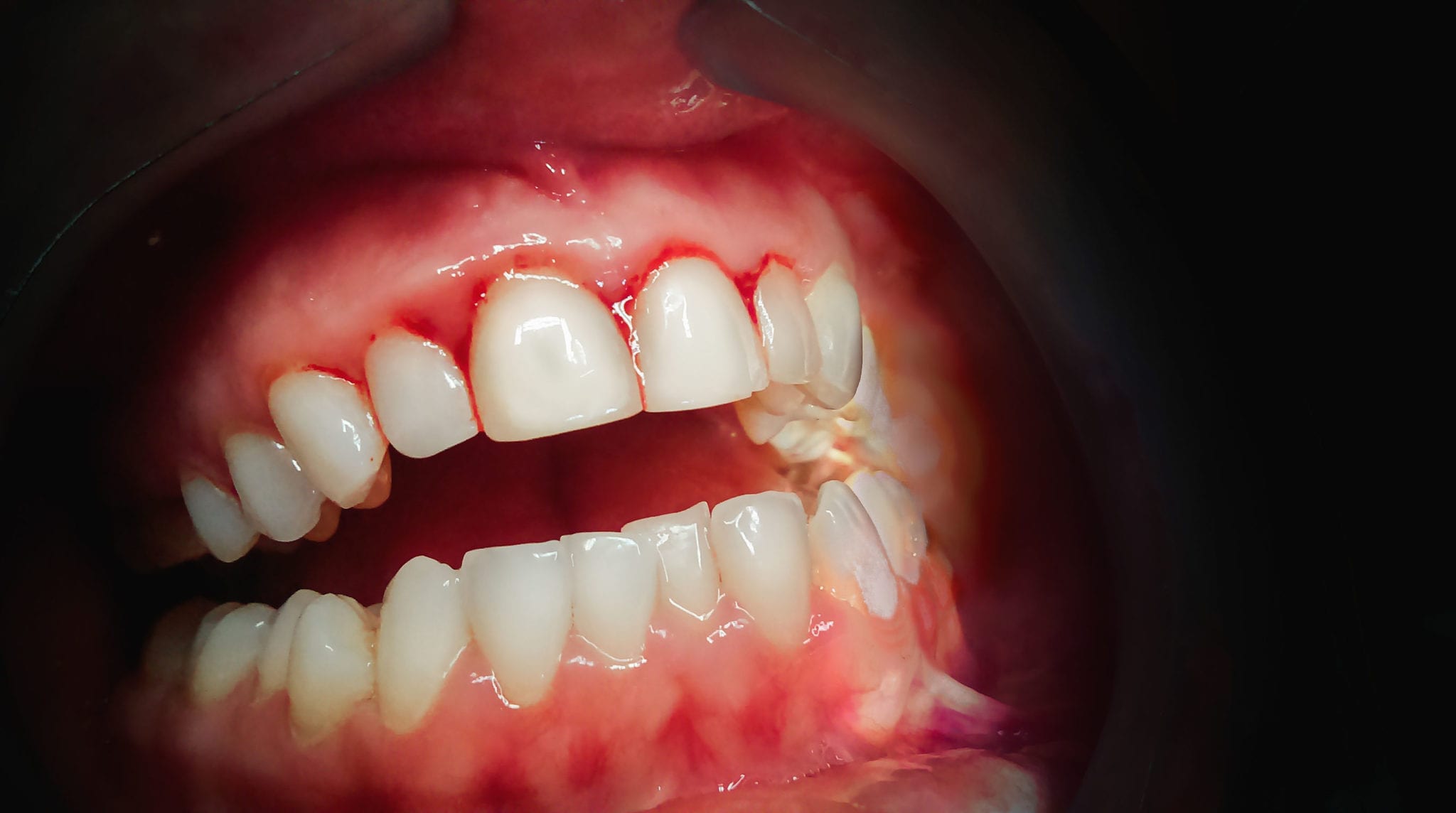 Sore or Bleeding Gums