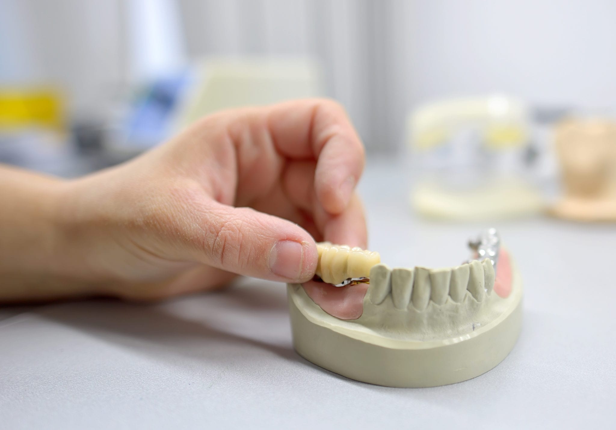 Benefits of Choosing a Fixed Bridge Over Dental Implants