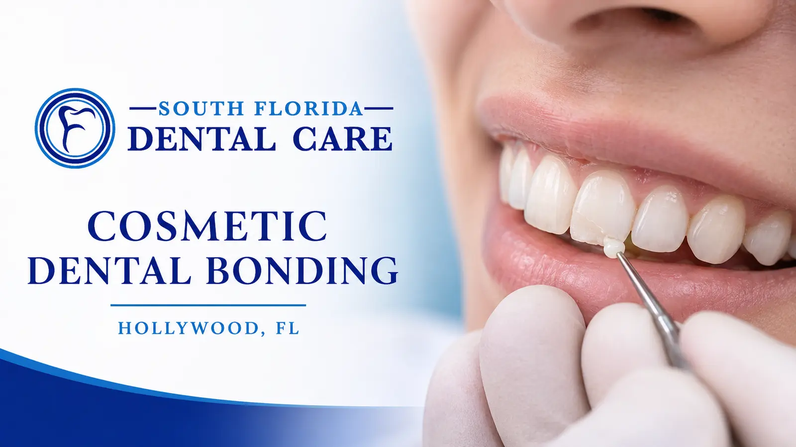 Cosmetic dental bonding treatment at South Florida Dental Care in Hollywood, FL