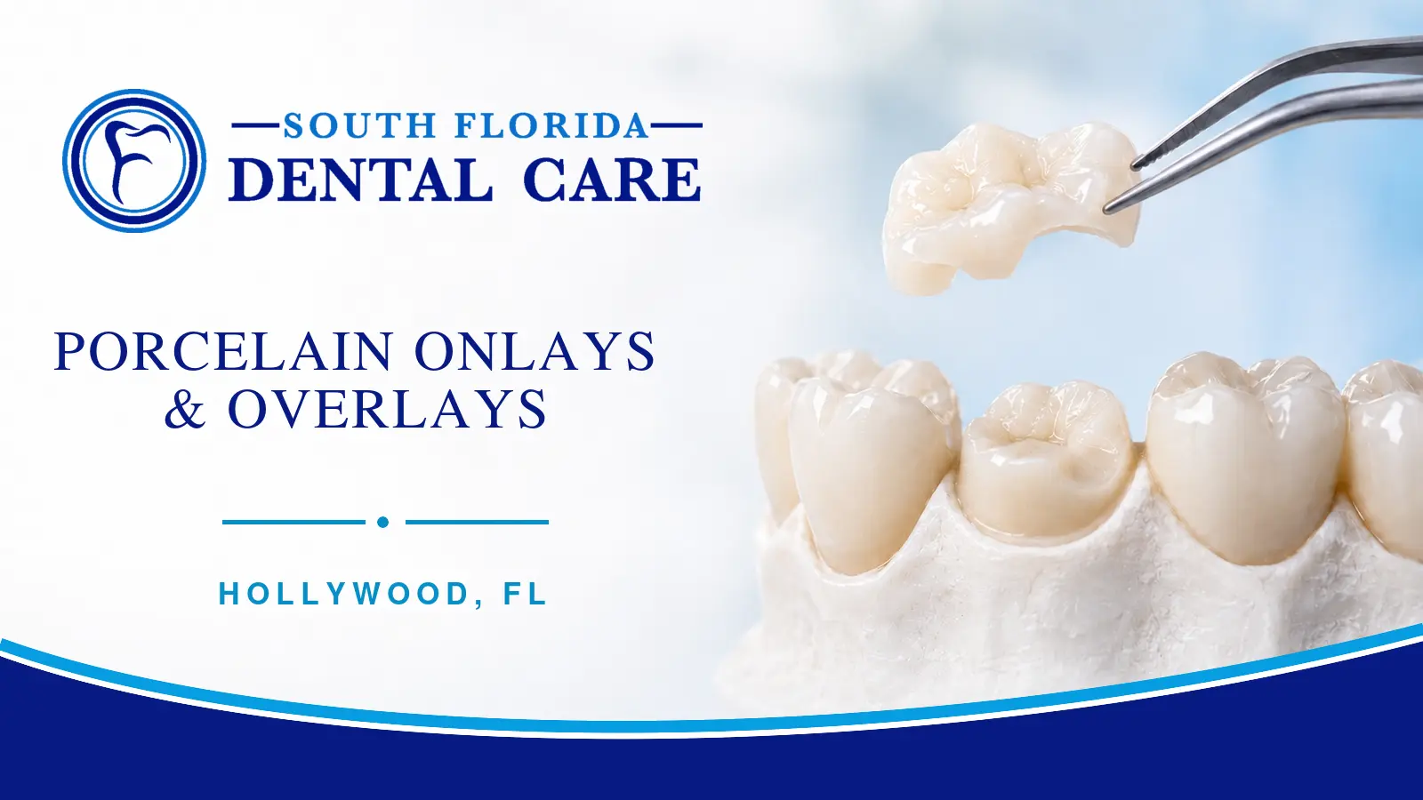 Porcelain onlay and overlay restoration at South Florida Dental Care in Hollywood, FL